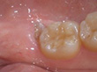 親知らずの抜歯 症例1
