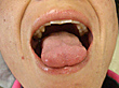 舌小帯　症例1