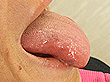 舌小帯 症例2