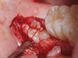 親知らずの抜歯 症例2