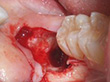 親知らずの抜歯 症例3