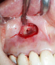 歯根嚢胞 症例2