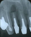 歯根嚢胞 症例レントゲン4