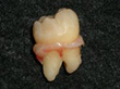 親知らずの抜歯 症例4