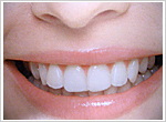 歯の黄ばみを解消して白い歯へ